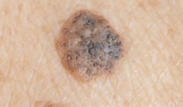 Seborrhoeic Keratosis: Benign vs Malignant Bromsgrove