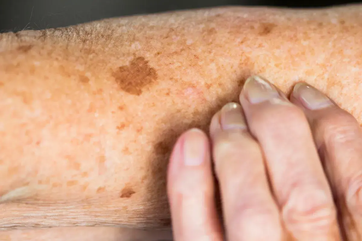 Sun Damage Aftercare and Skin Recovery Bromsgrove