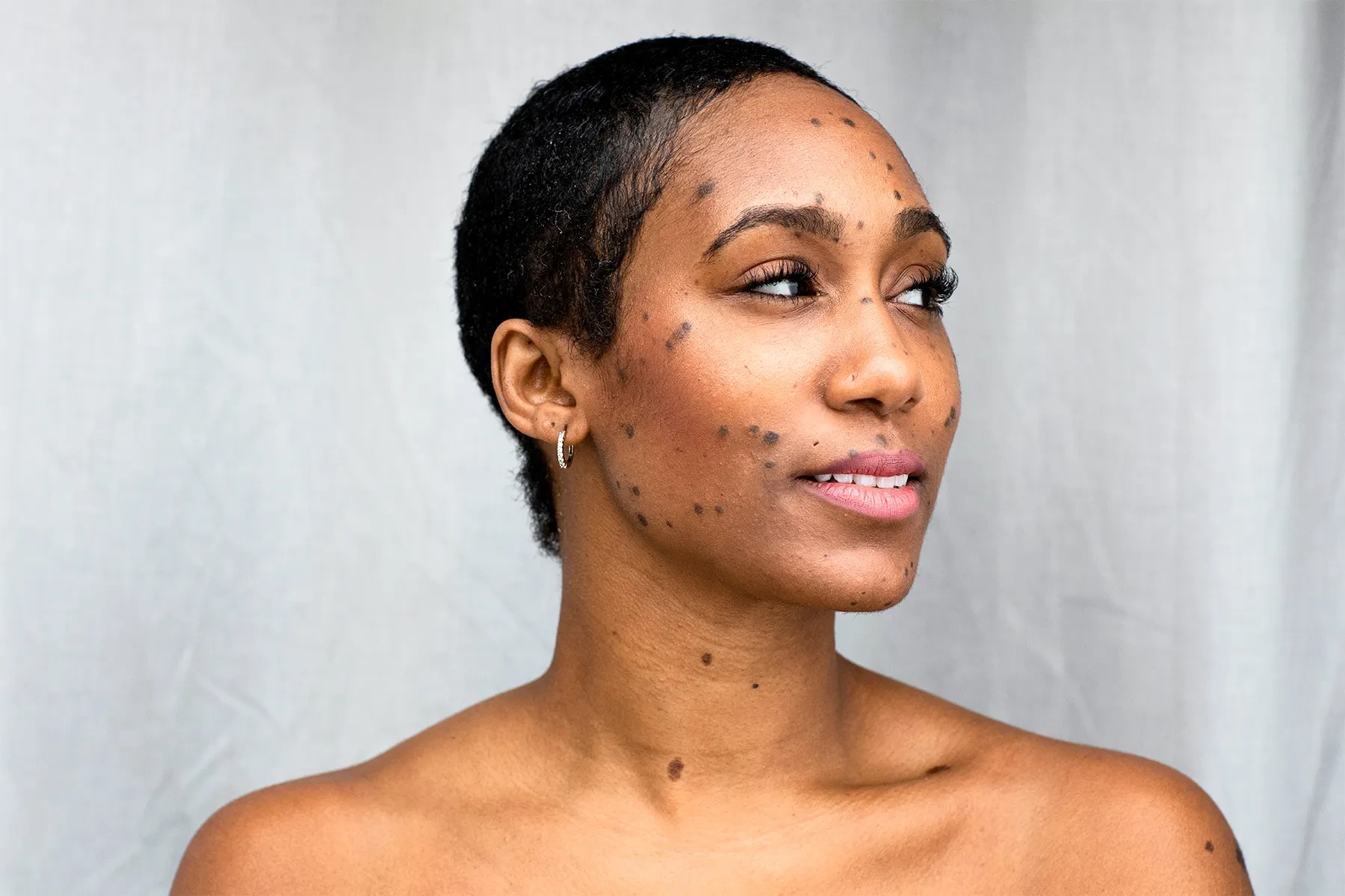 Dermatosis Papulosa Nigra on darker skin treated with Cryosonic CryoPen, showing genetic factors and effective removal Bromsgrove